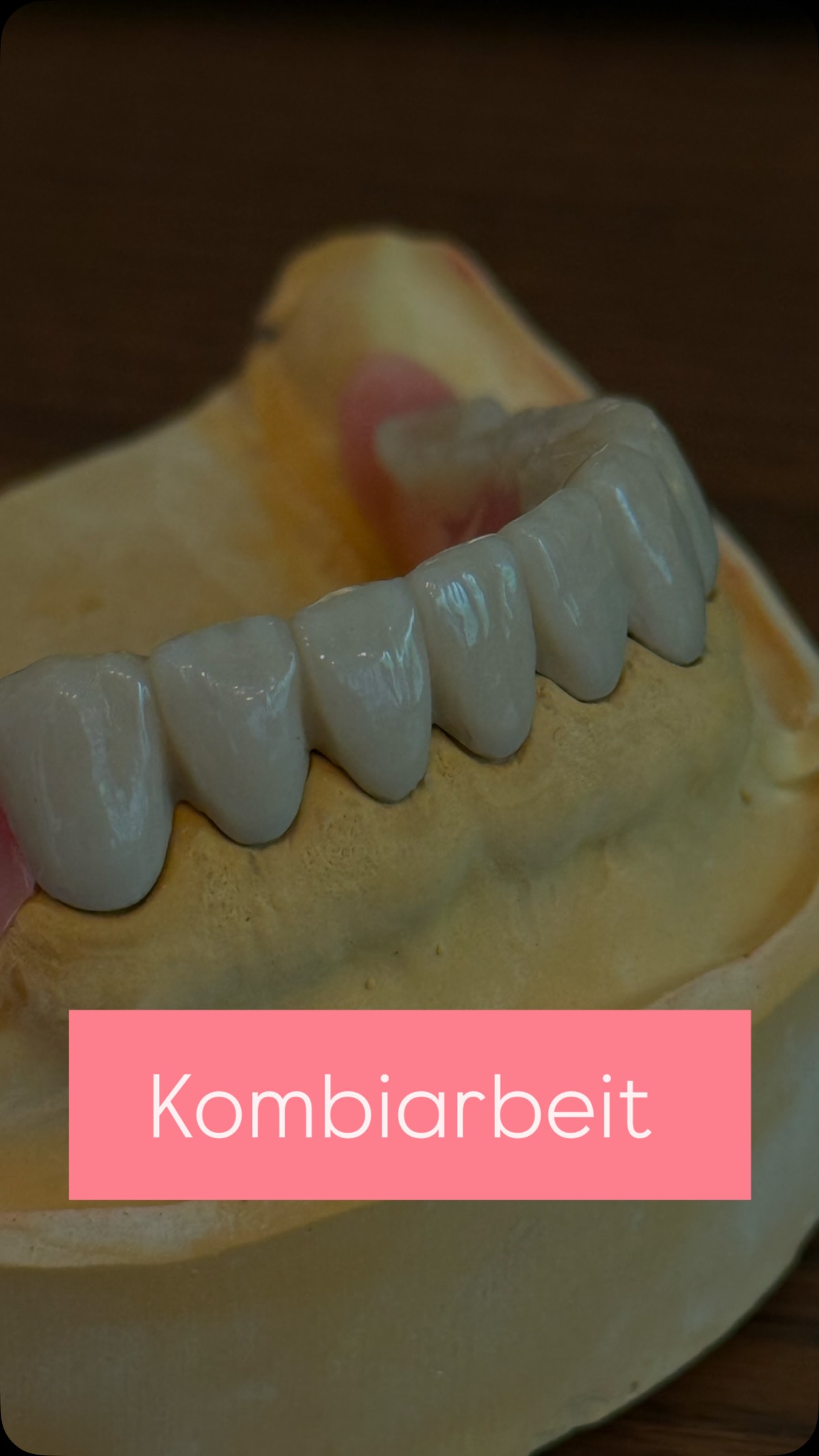 🦷 Kleiner Einblick in die analoge Zahntechnik
Analoge Kombi-Arbeit bedeutet echte Handarbeit, Präzision und Erfahrung – jedes Detail zählt. 🦷🔬
#Zahntechnik #handwerkmitpräzision #kombitechni #dentallabor #Zahnersatz